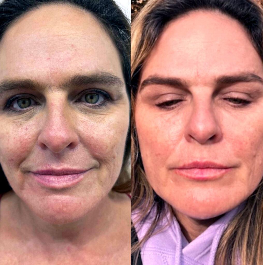 PRF treatment before and after