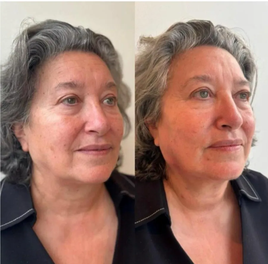 Aesthetics Clinic Melbourne - BLC Aesthetics - PRP Treatment