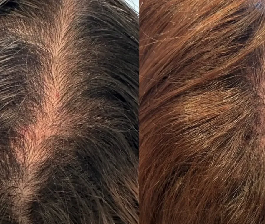 Aesthetics Clinic Melbourne - BLC Aesthetics - PRP Treatment