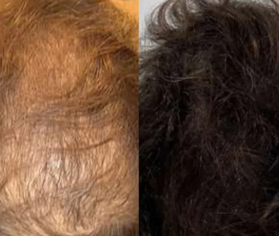 Aesthetics Clinic Melbourne - BLC Aesthetics - PRP Treatment