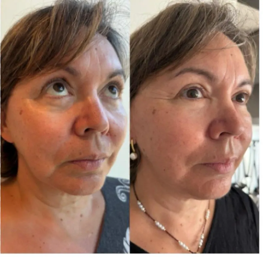 Aesthetics Clinic Melbourne - BLC Aesthetics - PRP Treatment