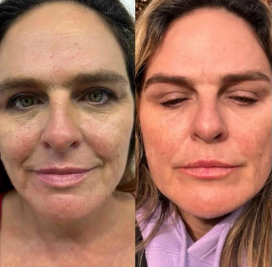 Aesthetics Clinic Melbourne - BLC Aesthetics - PRP Treatment